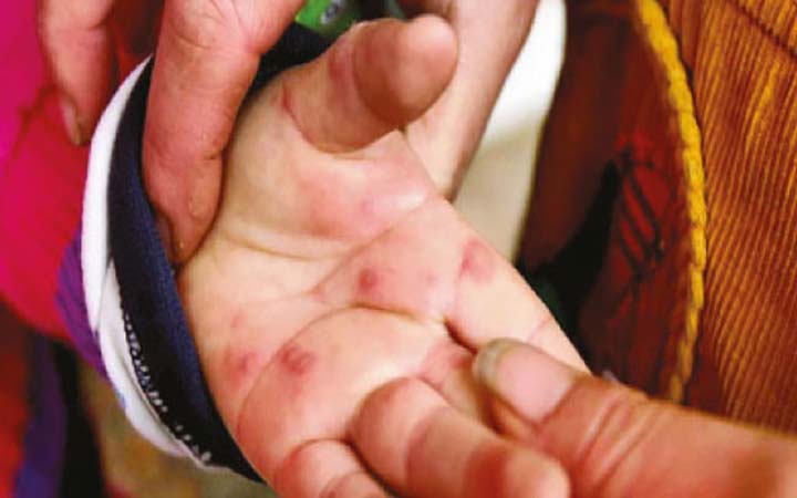 ভারতে টম্যাটো ফ্লু’র সংক্রমণ নিয়ে উদ্বেগ