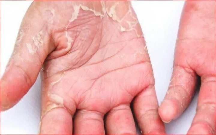 বর্ষায় হাতের চামড়া উঠছে? সমাধানে কী করবেন
