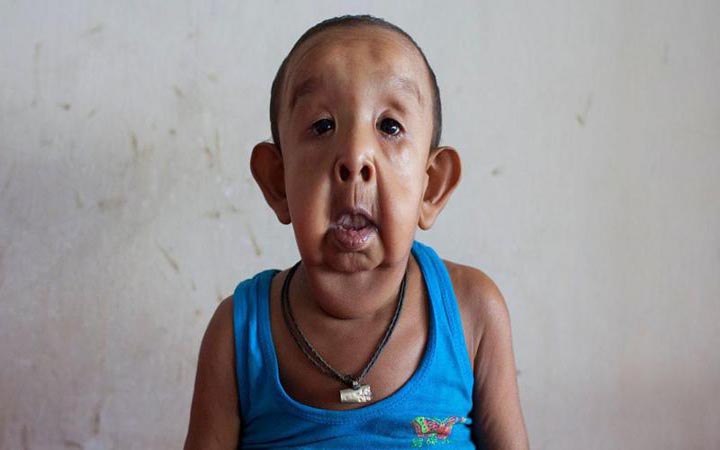শিশুকালে বুড়িয়ে যাওয়ার রোগ প্রোজেরিয়া কেন হয়?