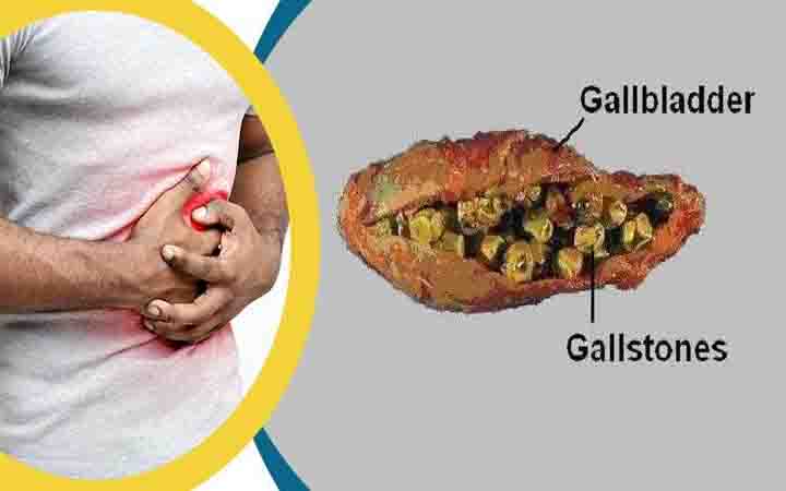ডায়াবেটিস রোগীদের পিত্তথলিতে পাথরের ঝুঁকি বেশি, জানুন লক্ষণ