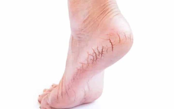 শীতে পায়ের গোড়ালি নরম রাখার উপায়