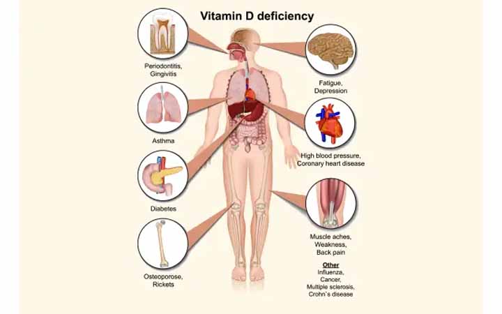 আপনার শরীরে ভিটামিন-ডি এর অভাব বোঝার উপায়