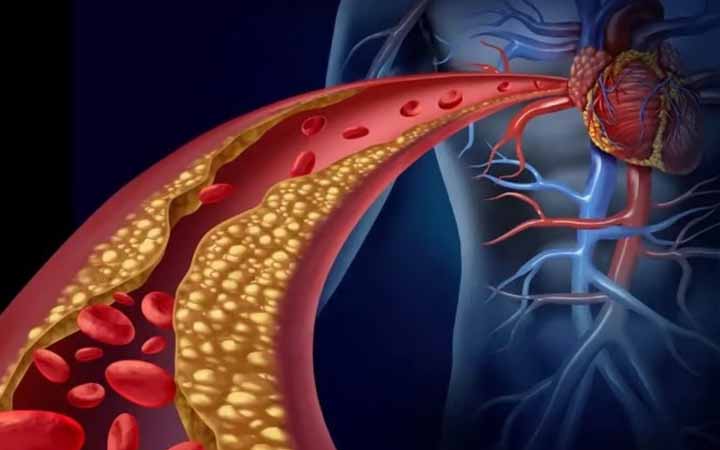 শরীরের কোলেস্টেরল এক নীরব ঘাতক!