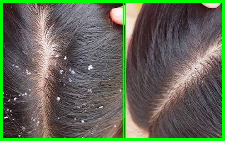 শীতকালে খুশকির সমস্যা দূর করার ঘরোয়া টোটকা