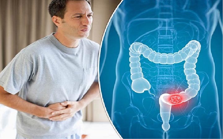 ওষুধ ছাড়াই ঘরোয়া উপায়ে কোষ্ঠকাঠিন্য সমাধান