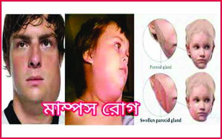 মাম্পস রোগের লক্ষণ ও চিকিৎসা