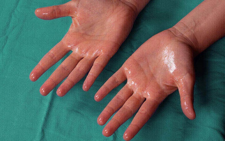 হাইপারহাইড্রোসিস : লক্ষণ ও কারণ