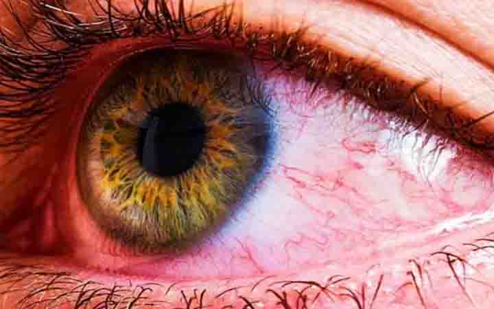 শীতের মৌসুমে হঠাৎ চোখে জ্বালাপোড়া হওয়ার কারণ
