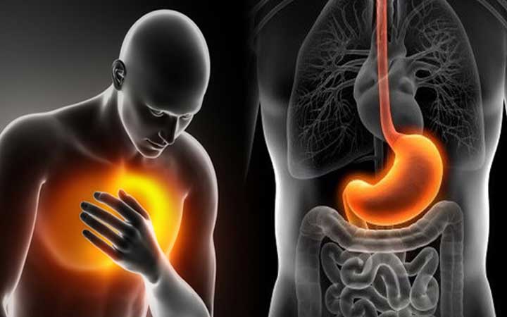 গ্যাস্টিক থেকে বাঁচার ঘরোয়া উপায়