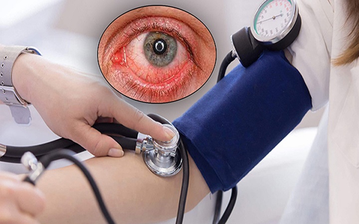 অনিয়ন্ত্রিত উচ্চ রক্তচাপে চোখের ক্ষতি