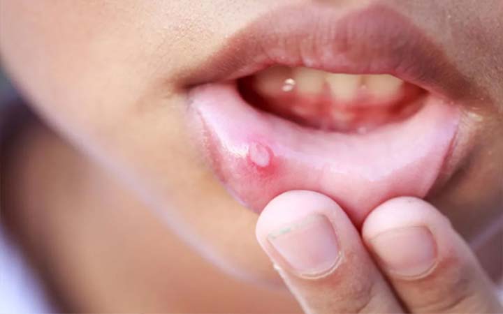 মুখের আলসার থেকে ক্যান্সার, কারণ ও চিকিৎসা