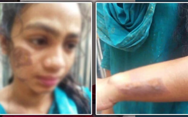 সৎমায়ের নির্মম নির্যাতনের শিকার এক শিশু