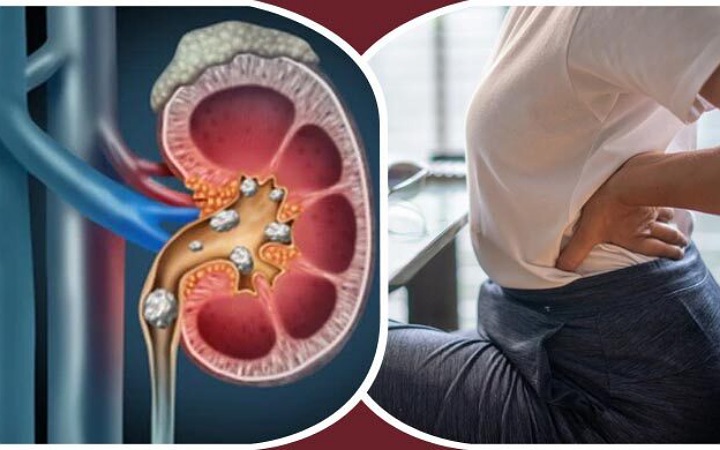 যে কারনে বাড়ছে কিডনিতে পাথর হওয়ার ঝুঁকি?