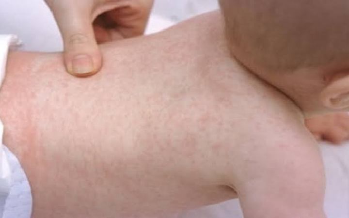 গরমে ঘামাচি হলে করণীয় কী?