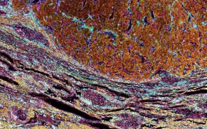 লিভার ক্যান্সার শনাক্তে চীনা গবেষকের নেতৃত্বে নতুন প্রযুক্তি