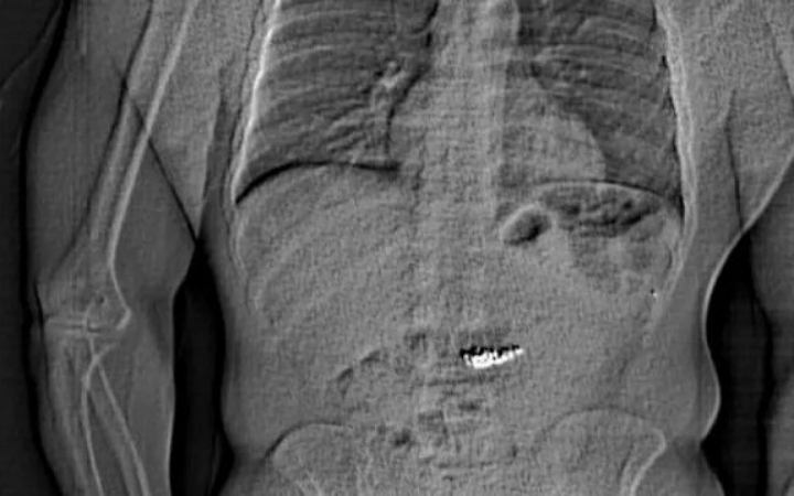 যুক্তরাষ্ট্রে চোরের পেট থেকে হিরার কানের দুল উদ্ধার