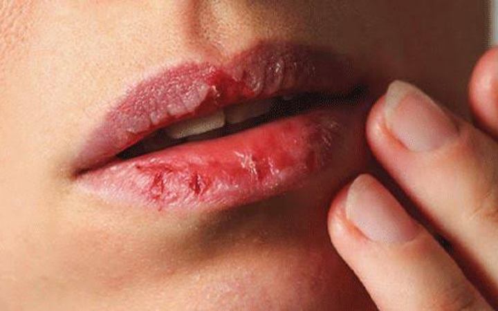 গরমে ঠোট ফাটলে করনীয় কি?