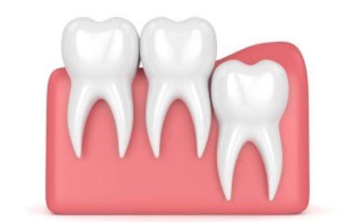 দাঁত ব্যথায় লবঙ্গ ও পেয়ারা পাতায় বিশেষ উপকারিতা