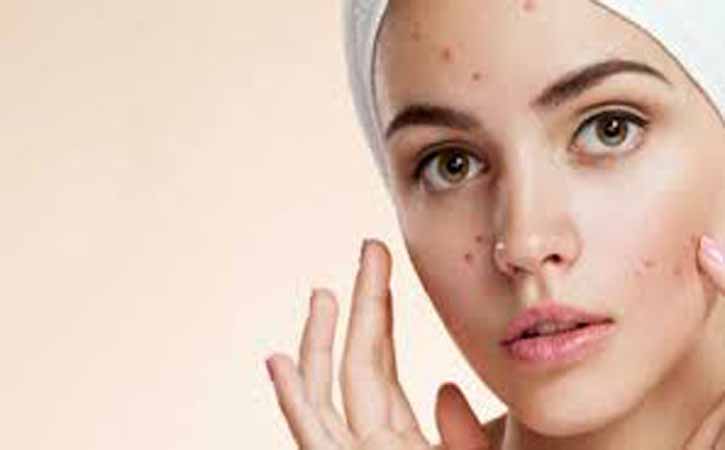 ব্রণ: চিকিৎসা ও প্রতিকার
