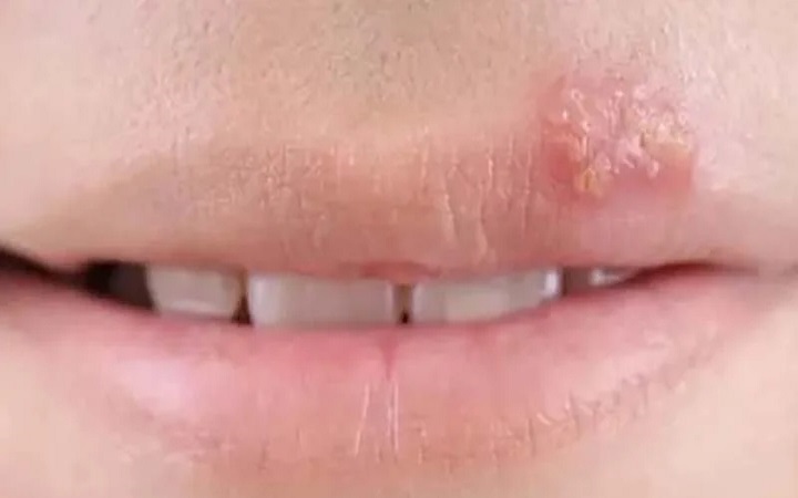 শীতে জ্বরঠোসা হচ্ছে? সারাবেন যেভাবে
