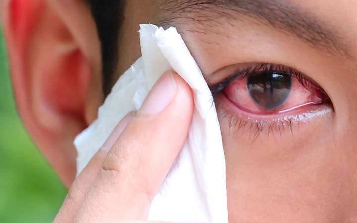 পাকিস্তানে চোখ ওঠা রোগের পরিস্থিতি ভয়াবহ