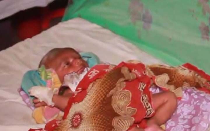 শিশুর ক্যানোলা খোলার সময় হাতের এক আঙ্গুল কেটে ফেলার অভিযোগ