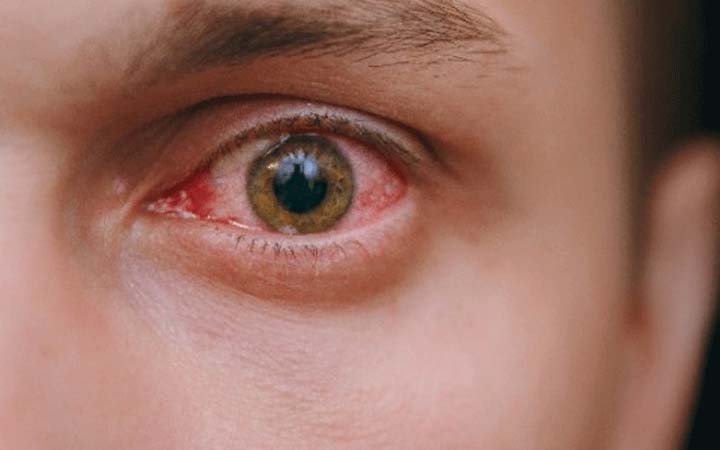 চোখ ওঠা রোগ থেকে সুস্থ থাকার দোয়া