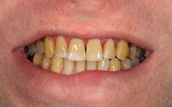 ধূমপানের জন্য দাঁত হলুদ হয়ে গেছে? কীভাবে দূর করবেন