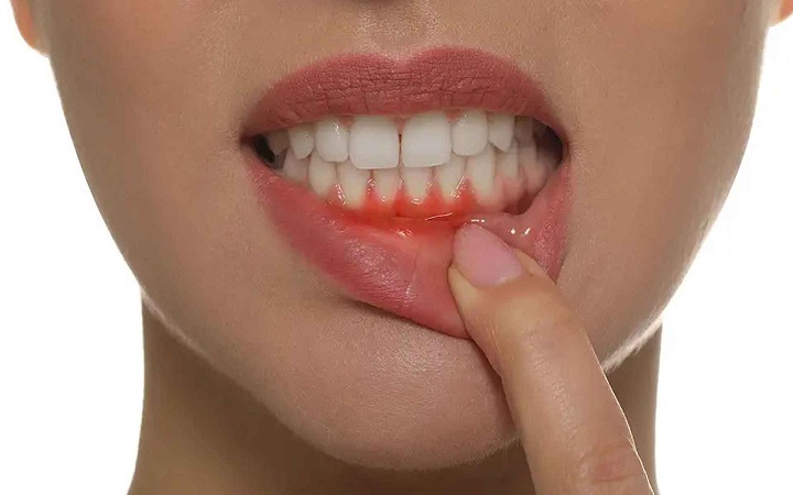 মাড়ি থেকে রক্ত পড়ার কারণ