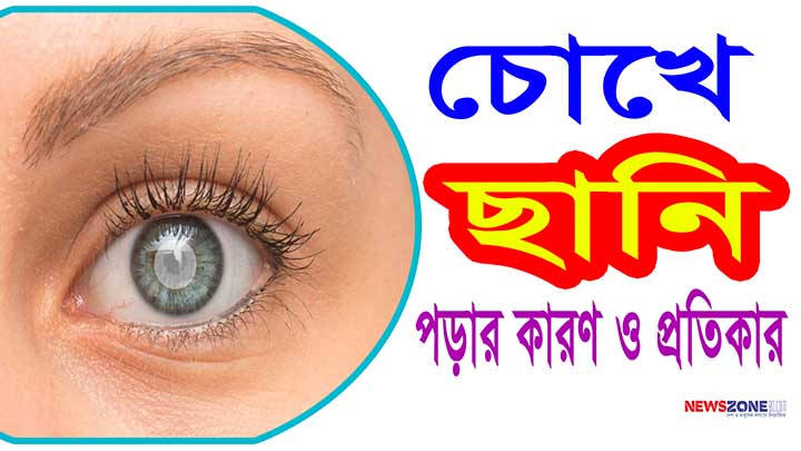 চোখে ছানি পড়ার কারণ ও প্রতিকার